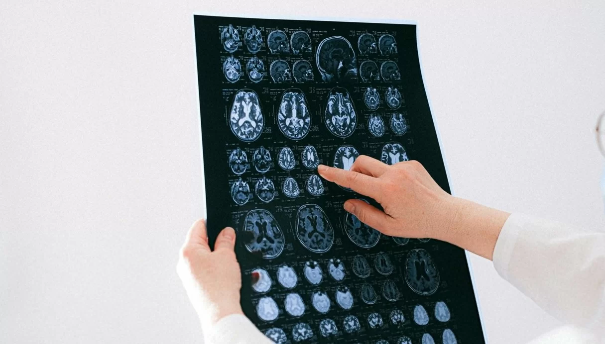 Ученые из США разработали прорывной метод восстановления мозга после инсульта