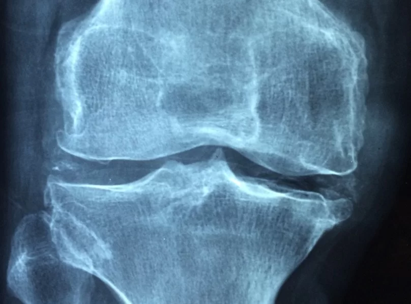 Шарнирный ортез помог уменьшить боль при остеоартрите коленного сустава