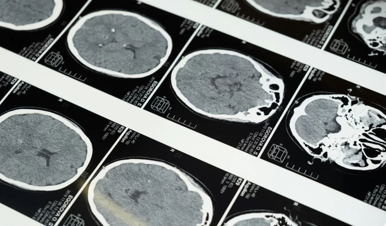 Китайские ученые связали деменцию с 16 болезнями внутренних органов