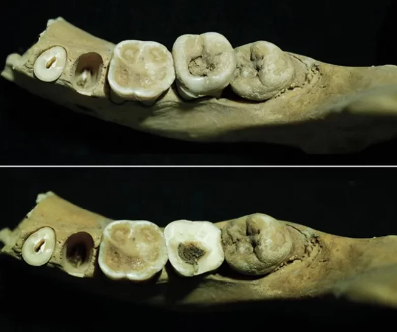 Учёные показали, что древние египтяне и римляне лечили зубы медом и травами